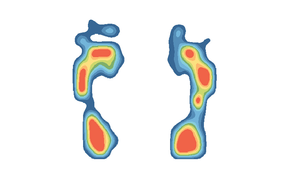 analyse de la pression plantaire